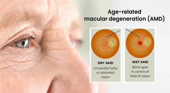 Saving Your Sight: Understanding and Treating Age-Related Macular Degeneration (AMD)